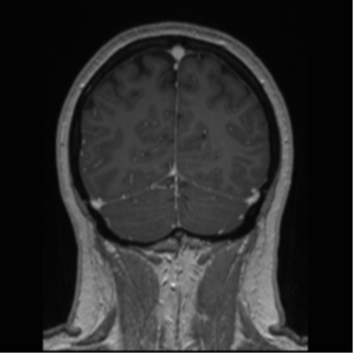 Cerebral cavernoma and development venous anomaly (Radiopaedia 37603-39482 Coronal T1 C+ 22).png