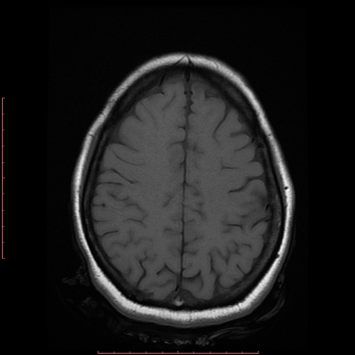 File:Cerebral cavernous malformation (Radiopaedia 26177-26306 Axial T1 16).jpg