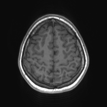 File:Cerebral cavernous venous malformation (Radiopaedia 70008-80021 Axial T1 72).jpg