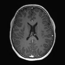 Cerebral cavernous venous malformation (Radiopaedia 70008-80021 Axial T1 C+ 49).jpg