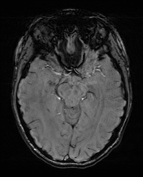 Cerebral cavernous venous malformation (Radiopaedia 70008-80021 I 30).jpg