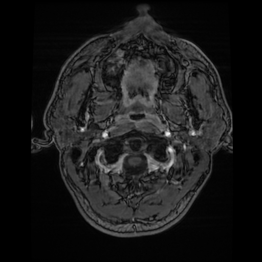 Cerebral cavernous venous malformation (Zabramski type II) (Radiopaedia 85511-101198 Axial T1 C+ fat sat 82).jpg
