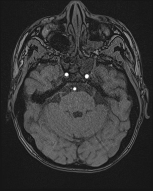 Cerebral embolic infarcts (embolic shower) (Radiopaedia 72391-82921 Axial MRA 36).jpg