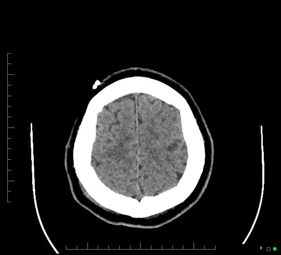 File:Cerebral fat embolism (Radiopaedia 85521-101220 Axial non-contrast 51).jpg