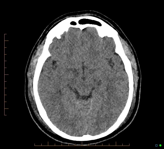 Cerebral fat embolism (Radiopaedia 85521-101224 Axial non-contrast 22).jpg