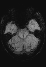 File:Cerebral hemorrhagic contusions- temporal evolution (Radiopaedia 40224-42757 Axial SWI 10).png