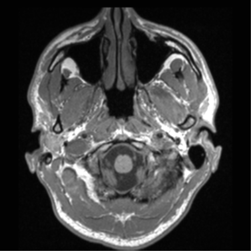 Cerebral hemorrhagic contusions- temporal evolution (Radiopaedia 40224-42757 Axial T1 9).png