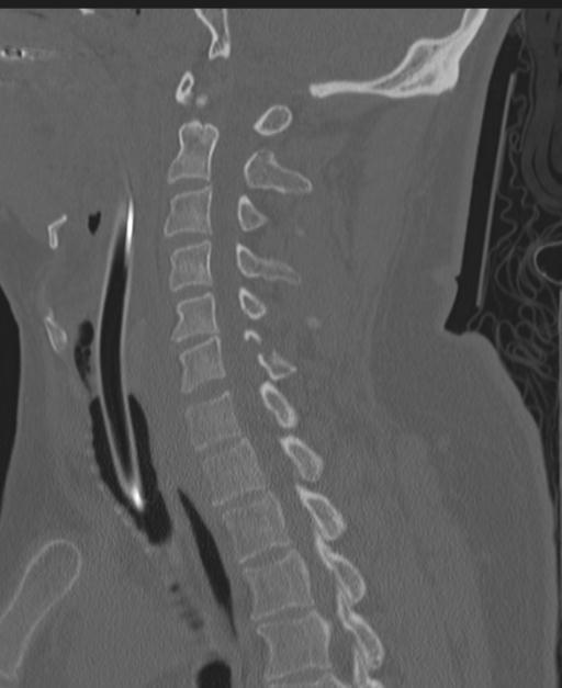 Cerebral hemorrhagic contusions and cervical spine fractures (Radiopaedia 32865-33841 Sagittal bone window 47).jpg
