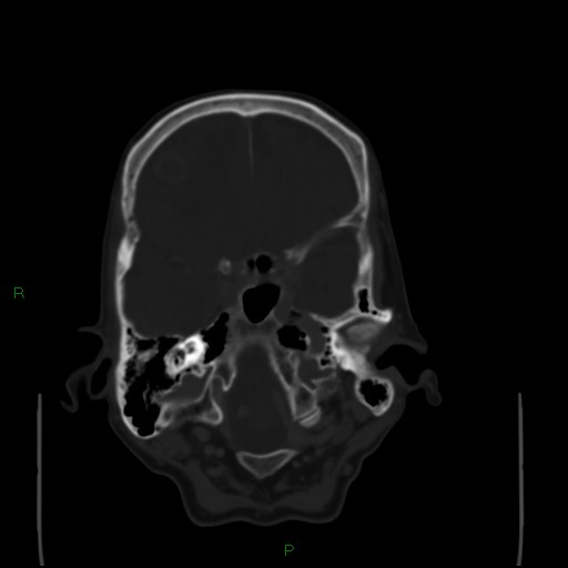 File:Cerebral metastases - breast primary (Radiopaedia 77653-89857 Axial bone window 28).jpg