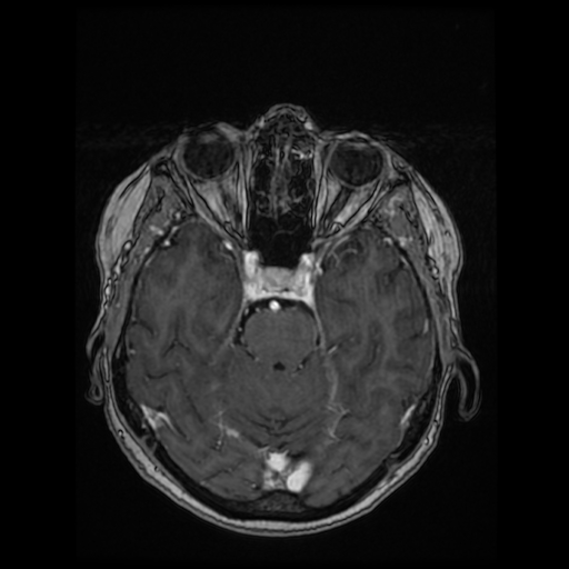 Cerebral metastases - melanoma (Radiopaedia 80972-94522 Axial T1 C+ 43).jpg