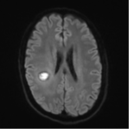 Cerebral metastasis - melanoma (Radiopaedia 54718-60954 Axial DWI 49).png