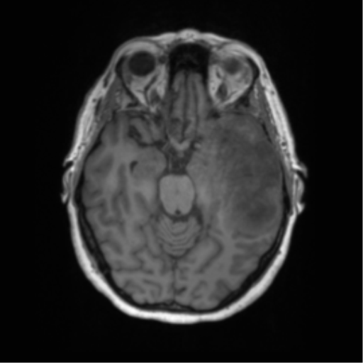 Cerebral metastasis mimicking glioblastoma (Radiopaedia 69155-78937 Axial T1 21).png