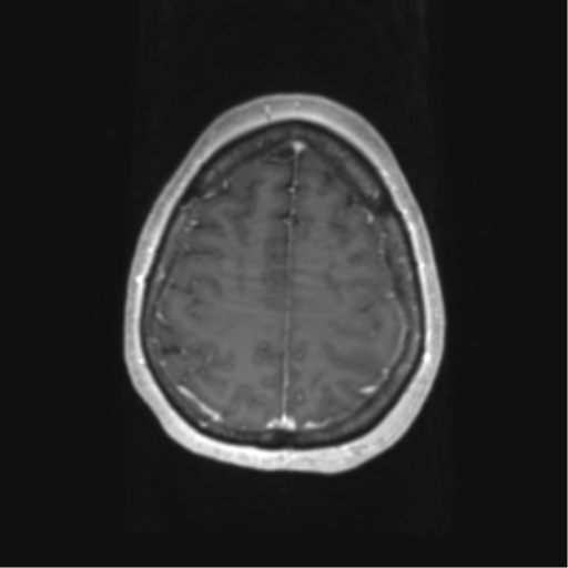 Cerebral metastasis mimicking glioblastoma (Radiopaedia 69155-78937 Axial T1 C+ 56).png