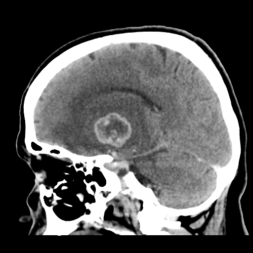 Cerebral metastasis to basal ganglia (Radiopaedia 81568-95412 Sagittal C+ delayed 25).png