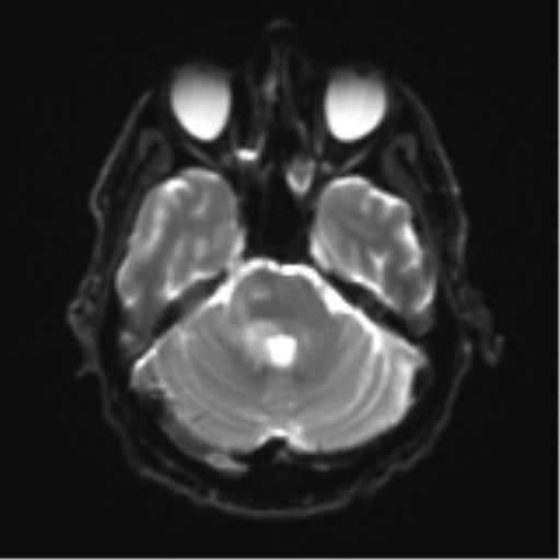 Cerebral toxoplasmosis (Radiopaedia 54575-60804 Axial DWI 11).png