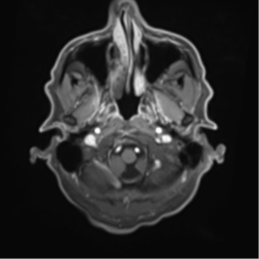 Cerebral toxoplasmosis (Radiopaedia 54575-60804 Axial T1 C+ 9).png