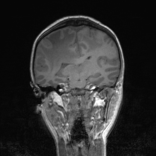 Cerebral tuberculosis with dural sinus invasion (Radiopaedia 60353-68090 Coronal T1 103).jpg