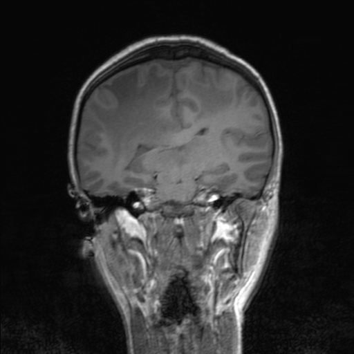 Cerebral tuberculosis with dural sinus invasion (Radiopaedia 60353-68090 Coronal T1 104).jpg
