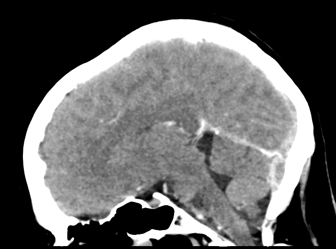 Cerebral venous hemorrhagic infarction (Radiopaedia 57576-64538 Sagittal C+ 26).png