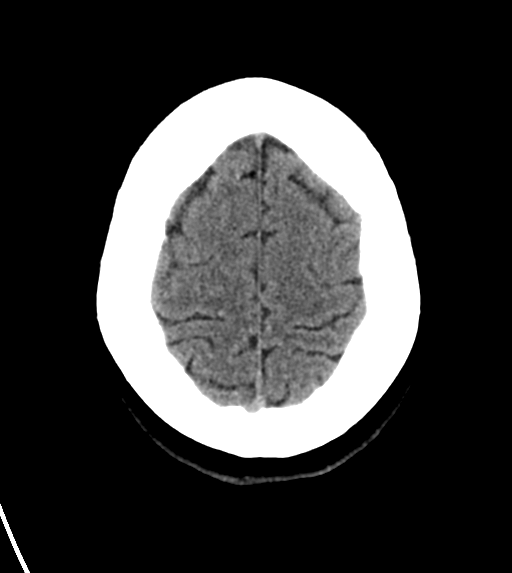 File:Cerebral venous infarct related to dural venous sinus thromboses (Radiopaedia 35292-36804 Axial non-contrast 25).png