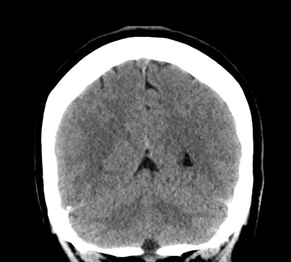 File:Cerebral venous infarct related to dural venous sinus thromboses (Radiopaedia 35292-36804 Coronal non-contrast 27).png