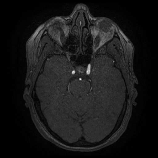 Cerebral venous infarction (Radiopaedia 25109-25363 MRA 7).jpg