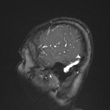 Cerebral venous infarction - hemorrhagic (Radiopaedia 81625-95505 Sagittal MRV 12).jpg