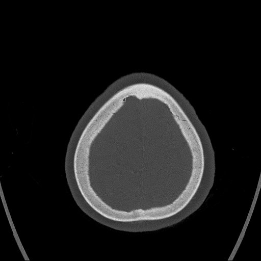 Cerebral venous infarction with hemorrhage (Radiopaedia 65343-74381 Axial bone window 171).jpg