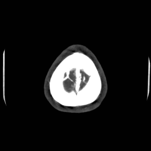 Cerebral venous sinus thrombosis (Radiopaedia 40619-43227 A 220).jpg