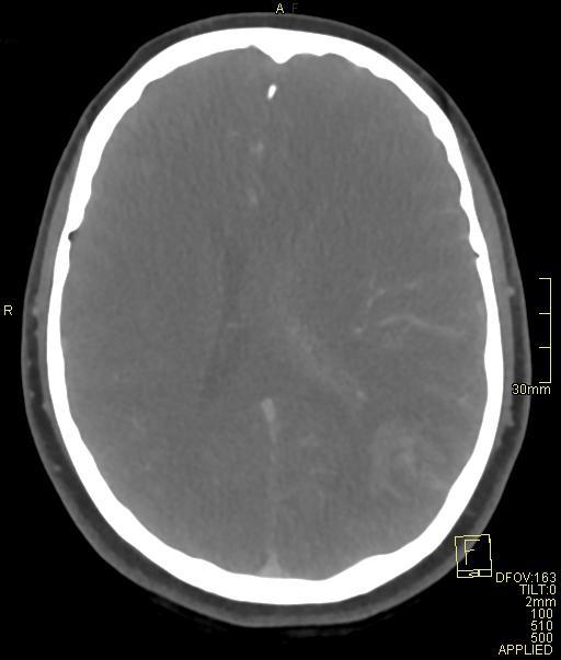 Cerebral venous sinus thrombosis (Radiopaedia 91329-108965 Axial venogram 49).jpg
