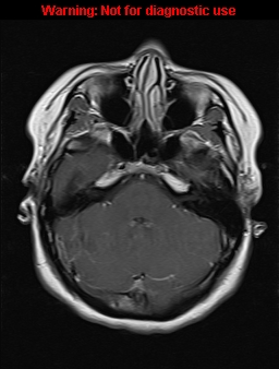 File:Cerebral venous thrombosis (Radiopaedia 37224-39208 Axial T1 C+ 6).jpg