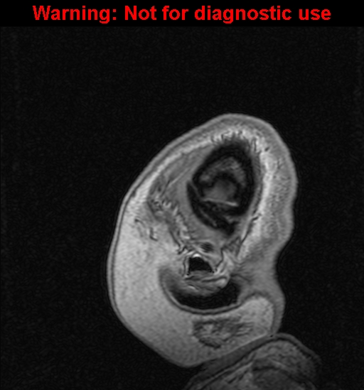 File:Cerebral venous thrombosis (Radiopaedia 37224-39208 Sagittal T1 C+ 147).jpg