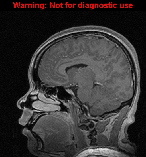 Cerebral venous thrombosis (Radiopaedia 37224-39208 Sagittal T1 C+ 69).jpg