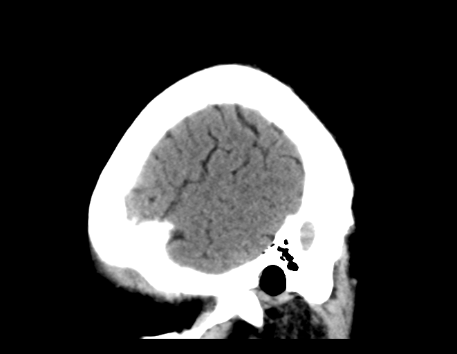 File:Cerebral venous thrombosis (Radiopaedia 38392-40467 C 5).png