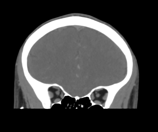 Cerebral venous thrombosis (Radiopaedia 38392-40467 Coronal CTA-Venogram 18).png