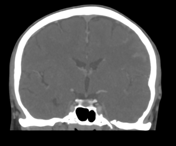 Cerebral venous thrombosis (Radiopaedia 38392-40467 Coronal CTA-Venogram 30).png