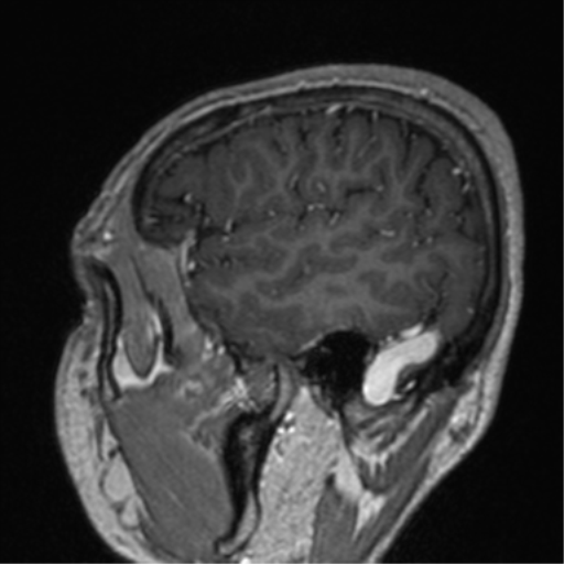 Cerebral venous thrombosis (Radiopaedia 38392-40469 Sagittal T1 C+ 19).png
