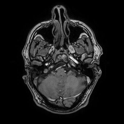 File:Cerebral venous thrombosis with secondary intracranial hypertension (Radiopaedia 89842-106957 Axial T1 C+ 51).jpg