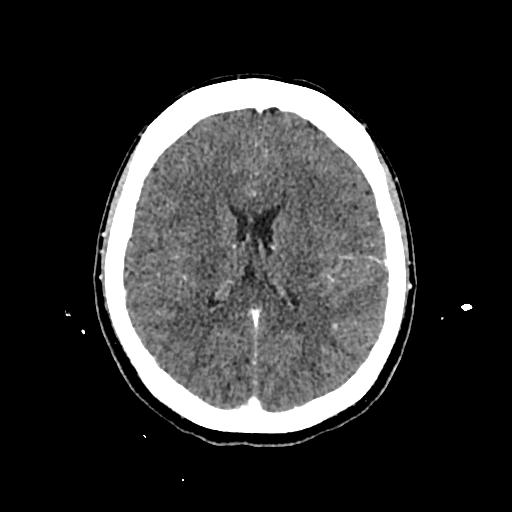 File:Cerebral venous thrombosis with venous hemorrhagic infarct (Radiopaedia 90354-107660 Axial with contrast 100).jpg