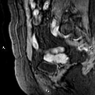 File:Cervical adenocarcinoma (Radiopaedia 65011-73985 E 5).jpg