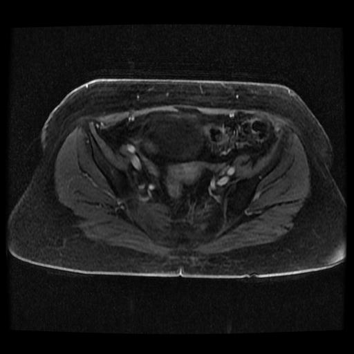 File:Cervical carcinoma (Radiopaedia 70924-81132 Axial T1 C+ fat sat 62).jpg