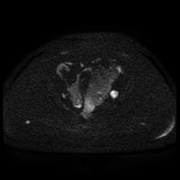 Cervical carcinoma (Radiopaedia 85405-101028 Axial DWI 73).jpg