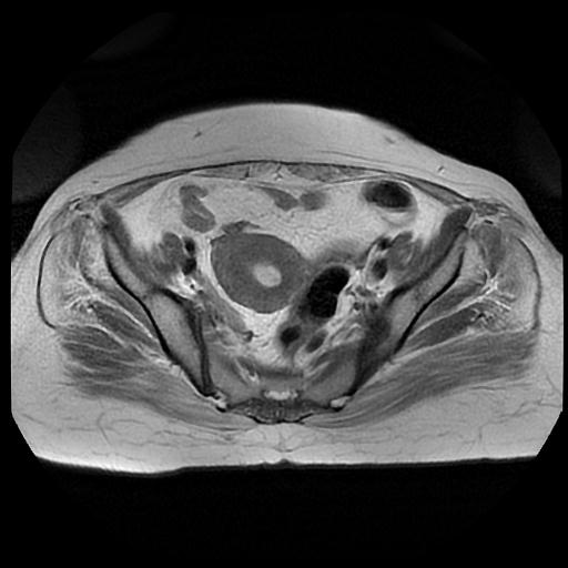 File:Cervical carcinoma (Radiopaedia 88010-104555 Axial T2 8).jpg