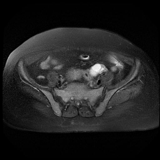 File:Cervical carcinoma (Radiopaedia 88010-104555 Axial T2 fat sat 4).jpg