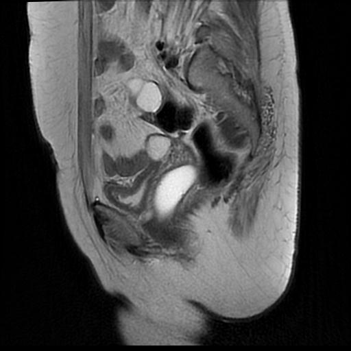 File:Cervical carcinoma (Radiopaedia 88010-104555 Sagittal T2 14).jpg