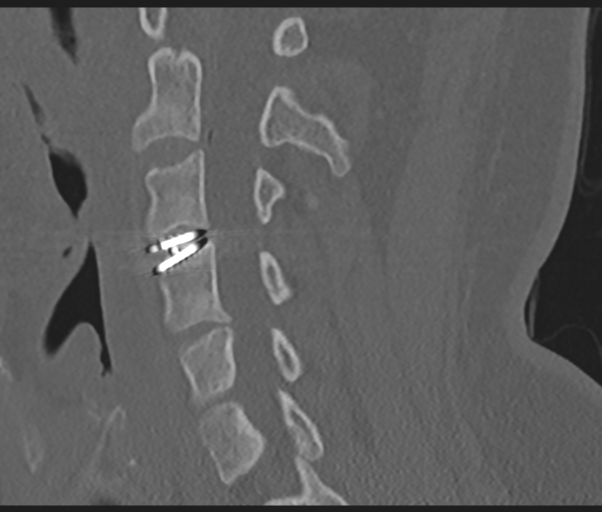 File:Cervical disc replacement (Radiopaedia 44025-47541 Sagittal bone window 48).png