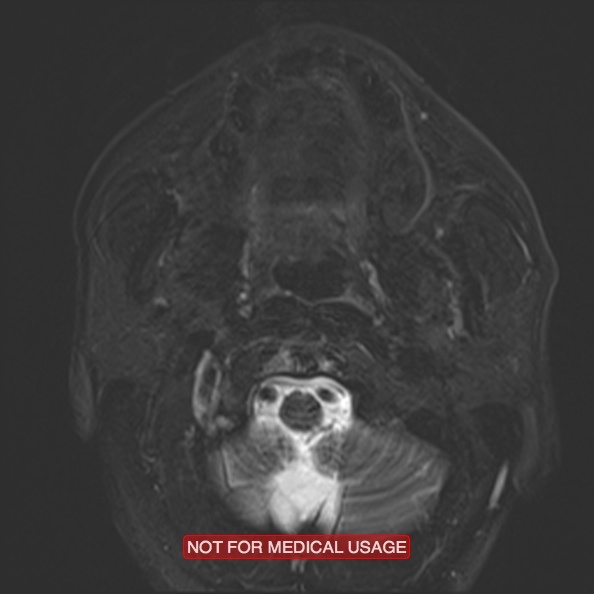 Cervical nerve schwannoma (Radiopaedia 27964-28221 C 19).jpg