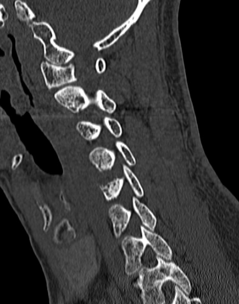 Cervical spondylodiscitis (Radiopaedia 28057-29489 Sagittal bone window 41).jpg