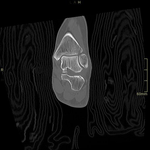 Chaput tubercle fracture (Radiopaedia 80319-93956 Coronal non-contrast 37).jpg