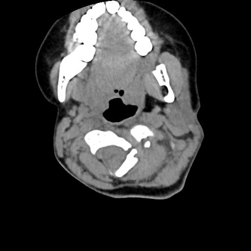 Chiari I with syrinx and skull base anomalies (Radiopaedia 89444-106412 Axial non-contrast 59).jpg